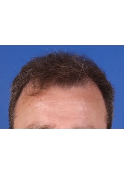 Before Hair Transplant&nbsp;Front